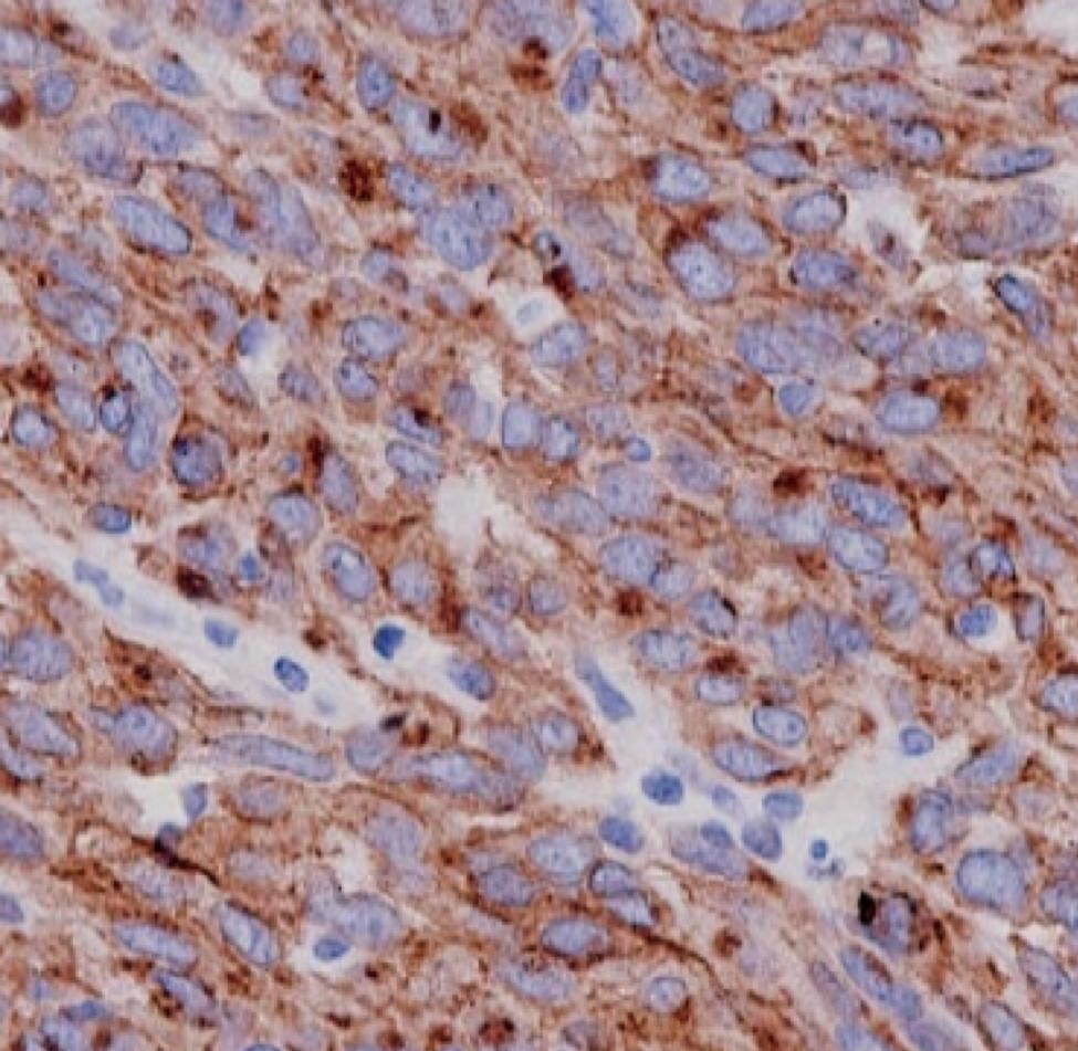 Dr Ghazi Zafar - Neuroendocrine Tumors, Possible Targets for Tyrosine Kinase Inhibitor Therapy